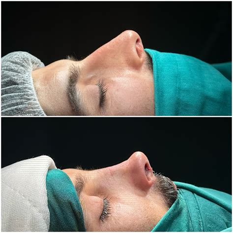 Watch this story by Op. Dr. Taylan ÇİL on Instagram before it .